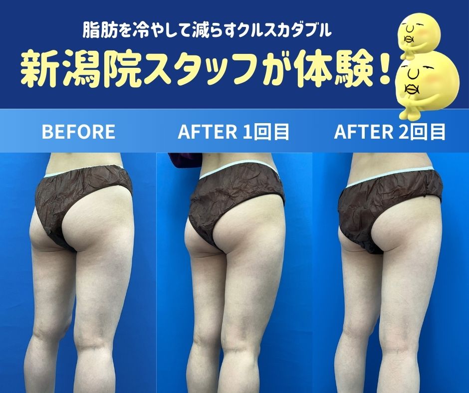 【新潟で医療痩身】SBCスタッフが脂肪冷却ダイエットを体験！内もも＆ヒップ下の施術レポ・効果・写真付き解説
